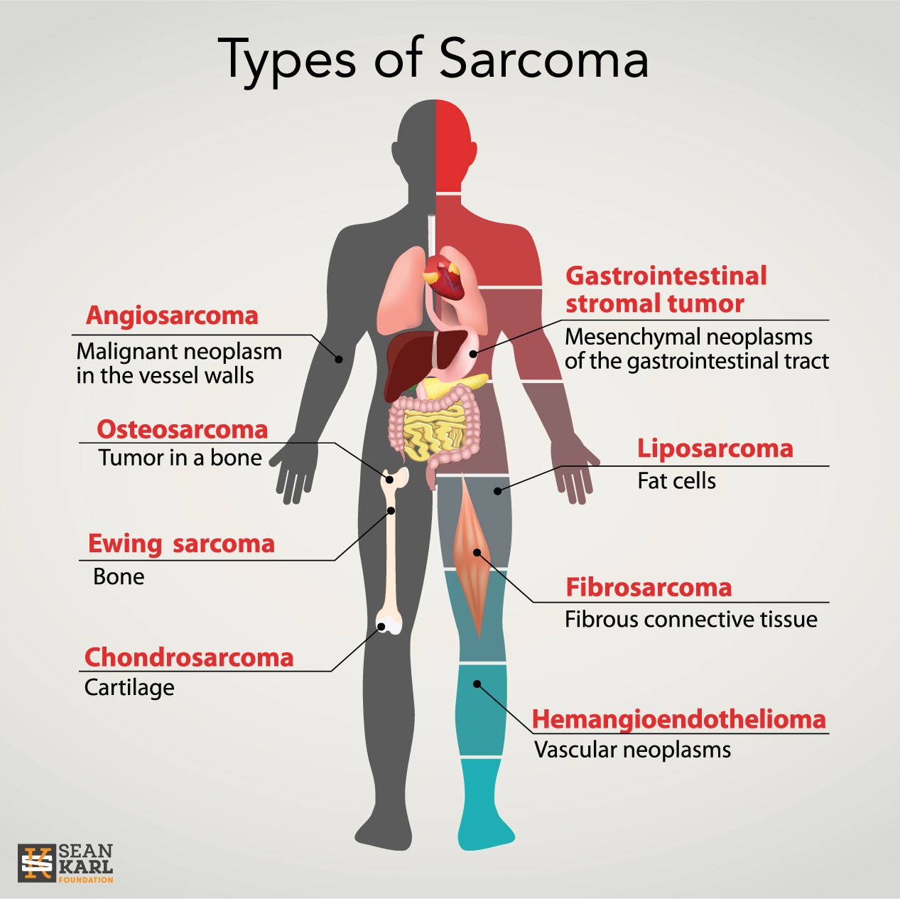 Sarcoma cancer pediatric. Microsatellite Instability (MSI)