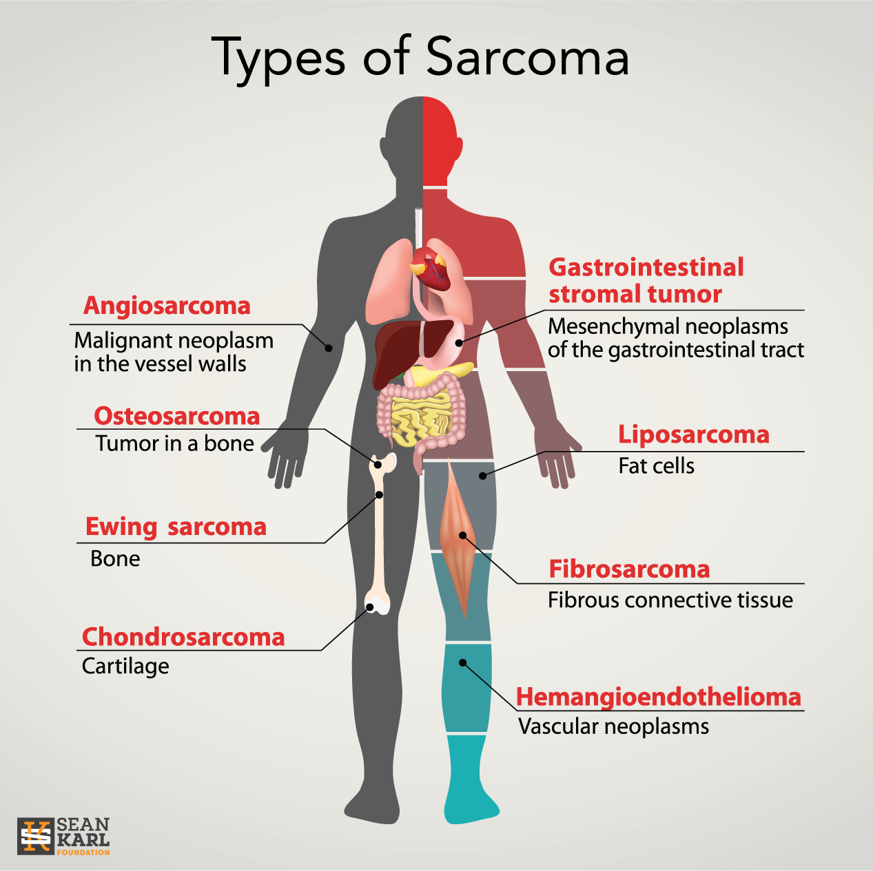 Soft Tissue Sarcoma Types